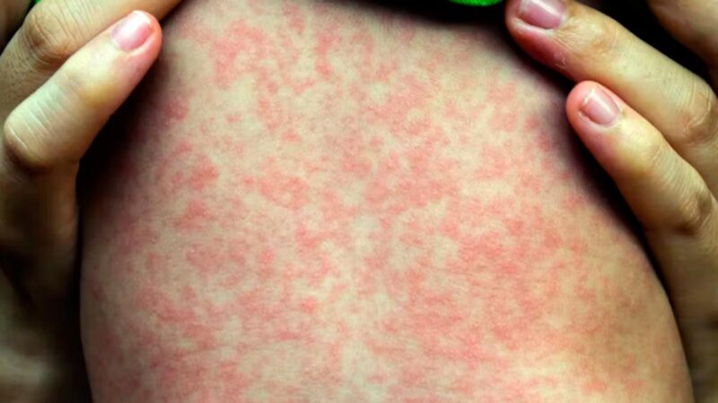 Ministerio de Salud emite alerta por sarampión: qué saber