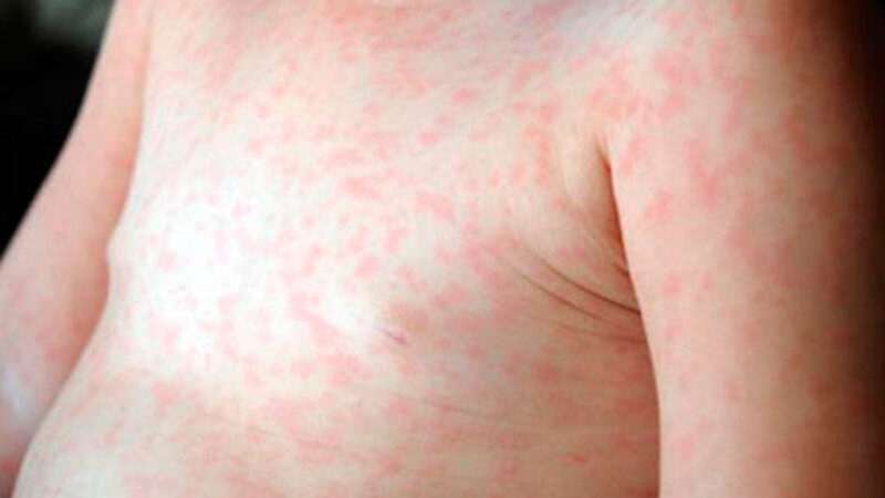 Sarampión: alerta en la provincia por cuatro casos importados