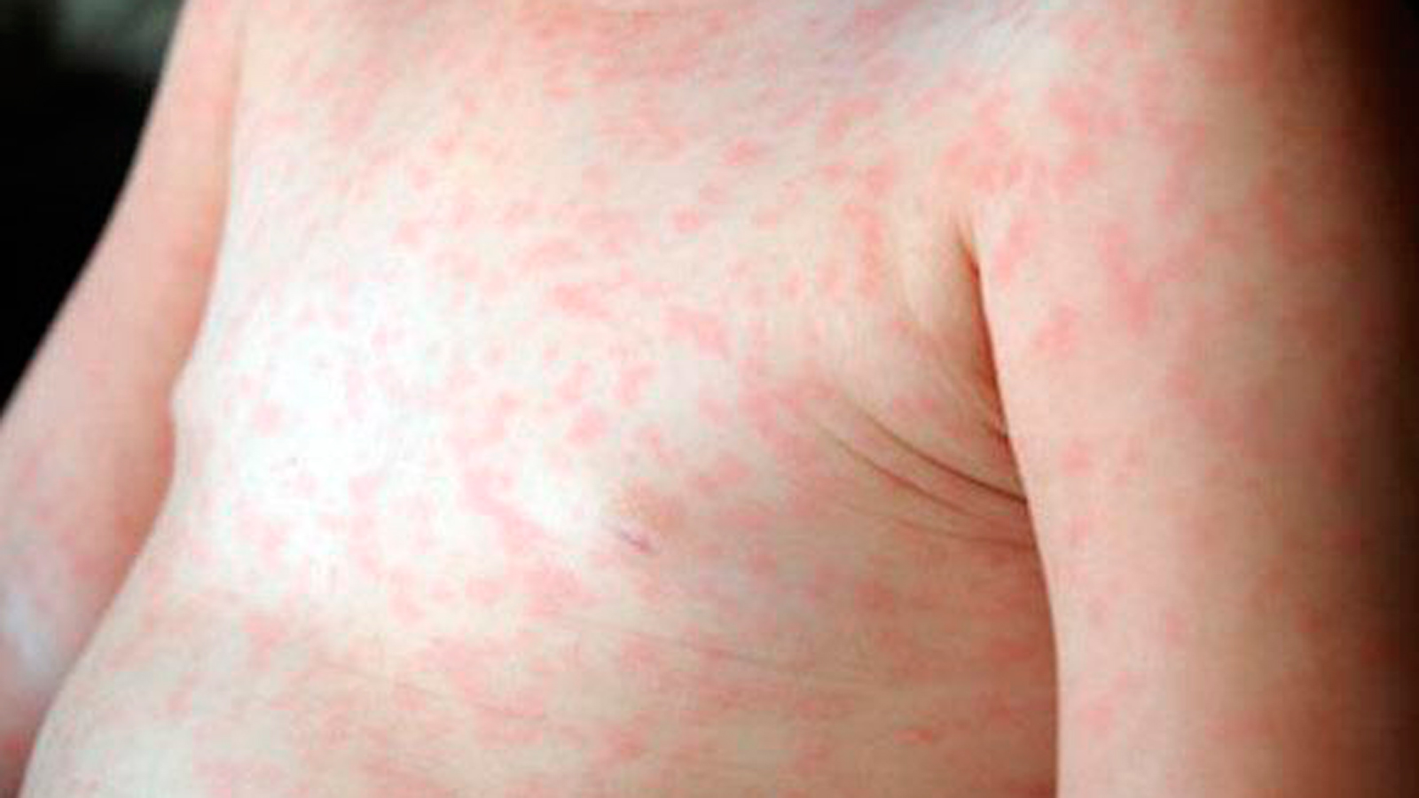 Sarampión: alerta en la provincia por cuatro casos importados